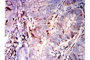 Immunohistochemical analysis of paraffin-embedded rectal cancer tissues using GSN mouse mAb with DAB staining. (Gelsolin Antikörper)