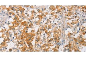 Immunohistochemistry of paraffin-embedded Human thyroid cancer using ARMCX3 Polyclonal Antibody at dilution of 1:40 (ARMCX3 Antikörper)