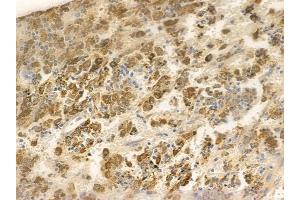 ABIN6256349 and ABIN6267599 at 1/100 staining human melanoma by IHC-P. (NF-kB p65 Antikörper  (pSer468))