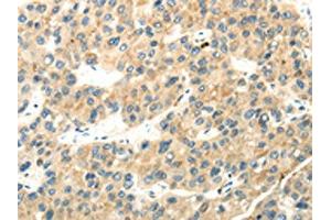The image on the left is immunohistochemistry of paraffin-embedded Human liver cancer tissue using ABIN7193040(WDR36 Antibody) at dilution 1/35, on the right is treated with synthetic peptide. (WDR36 Antikörper)