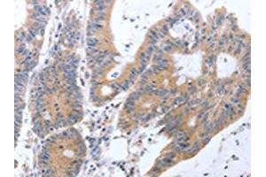The image on the left is immunohistochemistry of paraffin-embedded Human colon cancer tissue using ABIN7131299(TAT Antibody) at dilution 1/35, on the right is treated with fusion protein. (Tat Antikörper)