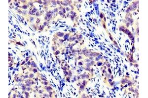 IHC image of ABIN7158430 diluted at 1:300 and staining in paraffin-embedded human pancreatic cancer performed on a Leica BondTM system. (LPP Antikörper  (AA 227-391))