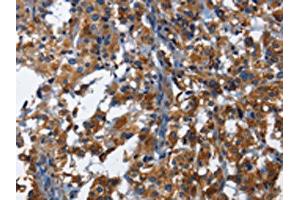 The image on the left is immunohistochemistry of paraffin-embedded Human thyroid cancer tissue using ABIN7130029(KLRB1 Antibody) at dilution 1/40, on the right is treated with fusion protein. (CD161 Antikörper)