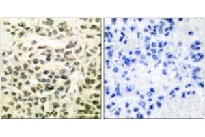 Immunohistochemistry analysis of paraffin-embedded human breast carcinoma tissue, using GSK3 alpha/beta (Ab-279/216) Antibody. (GSK3 alpha/beta Antikörper  (AA 246-295))