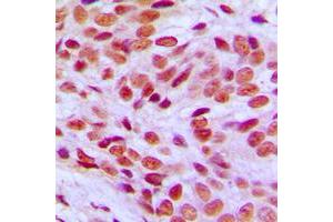 Immunohistochemical analysis of FLI1 staining in human breast cancer formalin fixed paraffin embedded tissue section.