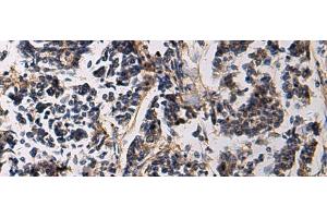 Immunohistochemistry of paraffin-embedded Human breast cancer tissue using SSH3 Polyclonal Antibody at dilution of 1:60(x200) (SSH3 Antikörper)