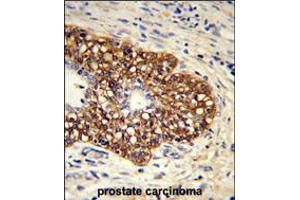 Formalin-fixed and paraffin-embedded human prostate carcinoma reacted with CYP8A1 Antibody , which was peroxidase-conjugated to the secondary antibody, followed by DAB staining. (PTGIS Antikörper  (C-Term))