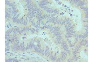 Immunohistochemistry of paraffin-embedded human colon cancer using ABIN7147246 at dilution of 1:100 (CADM1 Antikörper  (AA 45-344))