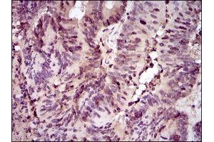 Immunohistochemical analysis of paraffin-embedded colon cancer tissues using PCNA mouse mAb with DAB staining. (PCNA Antikörper  (AA 53-196))