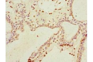 Immunohistochemistry of paraffin-embedded human breast cancer using ABIN7172156 at dilution of 1:100 (THRSP Antikörper  (AA 1-146))