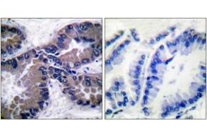 Immunohistochemistry analysis of paraffin-embedded human lung carcinoma tissue, using Nrf2 Antibody. (NRF2 Antikörper  (AA 556-605))
