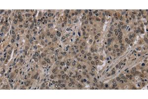 Immunohistochemistry of paraffin-embedded Human liver cancer using HIST1H2AH Polyclonal Antibody at dilution of 1:40 (HIST1H2AH Antikörper)