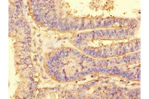 Immunohistochemistry of paraffin-embedded human endometrial cancer using ABIN7143770 at dilution of 1:100 (ALG2 Antikörper  (AA 303-405))