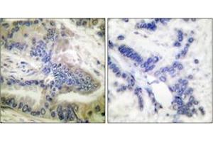 Immunohistochemistry analysis of paraffin-embedded human colon carcinoma, using Caspase 6 (Phospho-Ser257) Antibody. (Caspase 6 Antikörper  (pSer257))
