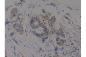 Detection of F1+2 in Human Pancreatic cancer Tissue using Polyclonal Antibody to Prothrombin Fragment 1+2 (F1+2) (Prothrombin Fragment 1+2 Antikörper)