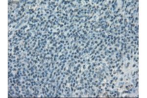 Immunohistochemical staining of paraffin-embedded lymphoma tissue using anti-PORmouse monoclonal antibody. (POR Antikörper)
