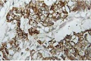 Immunohistochemistry (IHC) analyzes of HLA-DOalpha antibody in paraffin-embedded human breast carcinoma tissue. (HLA-DOA Antikörper)