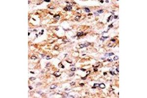 Formalin-fixed and paraffin-embedded human cancer tissue reacted with the primary antibody, which was peroxidase-conjugated to the secondary antibody, followed by AEC staining. (GCN2 Antikörper  (C-Term))