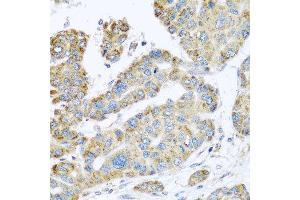 Immunohistochemistry of paraffin-embedded human liver cancer using SYT4 antibody at dilution of 1:100 (x40 lens). (SYT4 Antikörper)