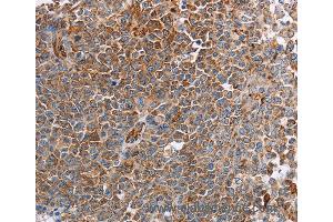 Immunohistochemistry of Human liver cancer using PLXNA2 Polyclonal Antibody at dilution of 1:40 (Plexin A2 Antikörper)