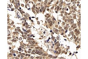 Immunohistochemistry analysis of paraffin-embedded human lung cancer using p27 Polyclonal Antibody at dilution of 1:200. (P27 Antikörper)