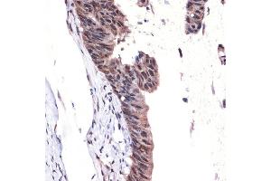 Immunohistochemistry of paraffin-embedded human colon carcinoma using MBD3 Rabbit mAb (ABIN7268492) at dilution of 1:100 (40x lens). (MBD3 Antikörper)