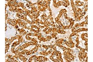 The image on the left is immunohistochemistry of paraffin-embedded Human thyroid cancer tissue using ABIN7130771(PTPN22 Antibody) at dilution 1/20, on the right is treated with fusion protein. (PTPN22 Antikörper)