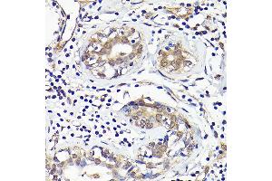 Immunohistochemistry of paraffin-embedded human breast cancer using IMPDH2 Rabbit pAb (ABIN7267853) at dilution of 1:100 (40x lens). (IMPDH2 Antikörper  (AA 215-514))