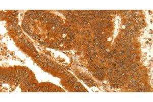 Immunohistochemistry of paraffin-embedded Human colon cancer using NAPA Polyclonal Antibody at dilution of 1:35 (NAPA Antikörper)
