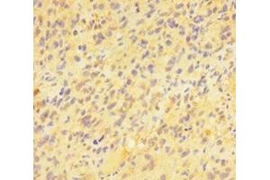 Immunohistochemistry of paraffin-embedded human glioma using ABIN7163391 at dilution of 1:100 (PAG1 Antikörper  (AA 97-432))