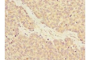 Immunohistochemistry of paraffin-embedded human ovarian cancer using ABIN7167152 at dilution of 1:100 (RASA4 Antikörper  (AA 60-290))