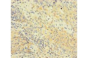 Immunohistochemistry of paraffin-embedded human cervical cancer using ABIN7174776 at dilution of 1:100 (C1orf112 Antikörper  (AA 301-530))