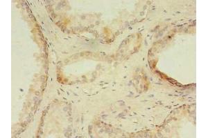 Immunohistochemistry of paraffin-embedded human prostate cancer using ABIN7176347 at dilution of 1:100 (ZNF501 Antikörper  (AA 6-305))