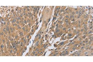 Immunohistochemistry of paraffin-embedded Human lung cancer using PTPN12 Polyclonal Antibody at dilution of 1:45 (PTPN12 Antikörper)