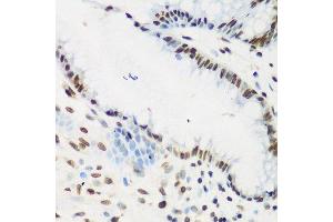 Immunohistochemistry of paraffin-embedded human stomach cancer using KLF4 antibody. (KLF4 Antikörper  (AA 180-479))