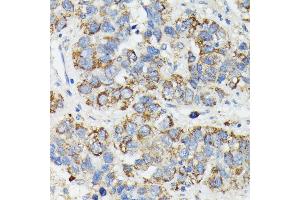 Immunohistochemistry of paraffin-embedded human liver cancer using MT-CYB antibody (ABIN7268595) at dilution of 1:100 (40x lens). (Cytochrome b Antikörper)