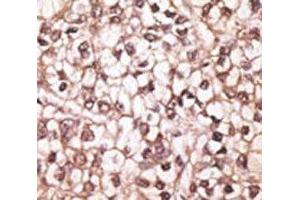 IHC analysis of FFPE human hepatocarcinoma tissue stained with the ABCB4 antibody (ABCB4 Antikörper  (AA 624-654))