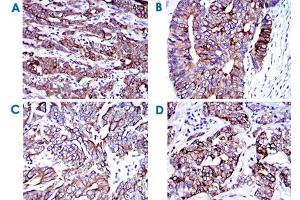 Immunohistochemical analysis of paraffin-embedded human cervical cancer (A) , human colon cancer (B) , human stomach cancer (C) and human bladder cancer (D) tissues using KRT19 monoclonal antibody, clone 4E8  with DAB staining. (Cytokeratin 19 Antikörper)