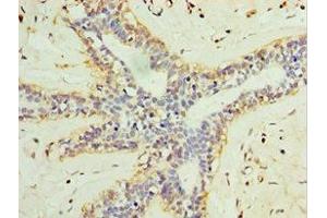 Immunohistochemistry of paraffin-embedded human breast cancer using ABIN7158005 at dilution of 1:100 (L3MBTL1 Antikörper  (AA 513-752))