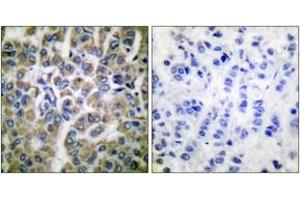 Immunohistochemistry analysis of paraffin-embedded human breast carcinoma tissue, using HSP10 Antibody. (HSPE1 Antikörper  (AA 51-100))