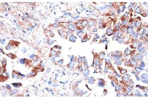 Immunohistochemistry of paraffin-embedded Human lung cancer using TIM-3/HAVCR2 Polyclonal Antibody at dilution of 1:200 (40x lens). (TIM3 Antikörper)