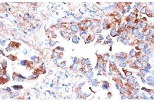Immunohistochemistry of paraffin-embedded Human lung cancer using TIM-3/HAVCR2 Polyclonal Antibody at dilution of 1:200 (40x lens).