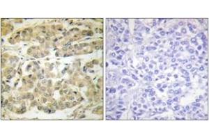 Immunohistochemistry analysis of paraffin-embedded human breast carcinoma, using 14-3-3 zeta (Phospho-Ser58) Antibody. (14-3-3 zeta Antikörper  (pSer58))