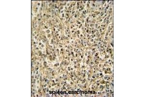 RNT2 antibody (N-term) (ABIN654720 and ABIN2844409) immunohistochemistry analysis in formalin fixed and paraffin embedded human spleen carcinoma followed by peroxidase conjugation of the secondary antibody and DAB staining. (RNASET2 Antikörper  (N-Term))