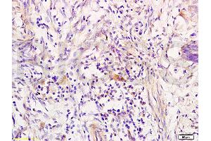 Formalin-fixed and paraffin embedded human colon carcinoma tissue labeled with Anti-RRM1 Polyclonal Antibody, Unconjugated (ABIN731543) at 1:200 followed by conjugation to the secondary antibody, (SP-0023), and DAB staining (RRM1 Antikörper  (AA 733-778))