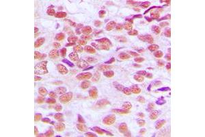 Immunohistochemical analysis of GSK3 alpha/beta staining in human breast cancer formalin fixed paraffin embedded tissue section. (GSK3 alpha/beta Antikörper  (Center))