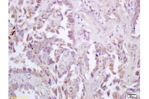 Formalin-fixed and paraffin embedded human lung carcinoma labeled with Rabbit Anti ChRM3/Acetylcholine receptor(M3) Polyclonal Antibody, Unconjugated (ABIN674484) at 1:200 followed by conjugation to the secondary antibody and DAB staining (CHRM3 Antikörper  (AA 481-589))