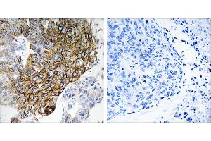 Peptide - +Immunohistochemistry analysis of paraffin-embedded human lung carcinoma tissue using GJA3 antibody.