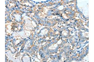 The image on the left is immunohistochemistry of paraffin-embedded Human thyroid cancer tissue using ABIN7128285(AGBL3 Antibody) at dilution 1/45, on the right is treated with fusion protein. (AGBL3 Antikörper)