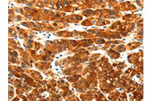 The image on the left is immunohistochemistry of paraffin-embedded Human liver cancer tissue using ABIN7191931(PLXNA3 Antibody) at dilution 1/25, on the right is treated with synthetic peptide. (Plexin A3 Antikörper)